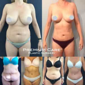 Mommy Makeover in Colombia at Premium Care Plastic Surgery