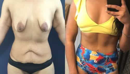 after weight loss colombia 106-1-min