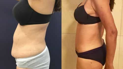 after weight loss colombia 120-3-min