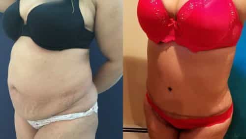 after weight loss colombia 134-1-min