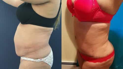 after weight loss colombia 134-2-min