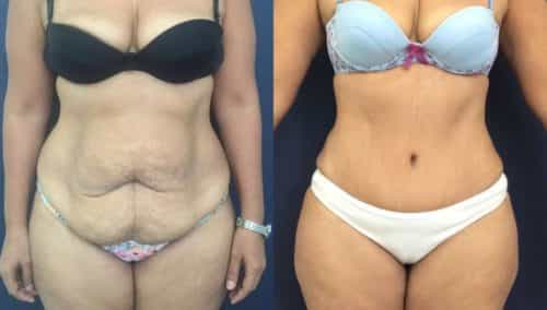 after weight loss colombia 154-1-min