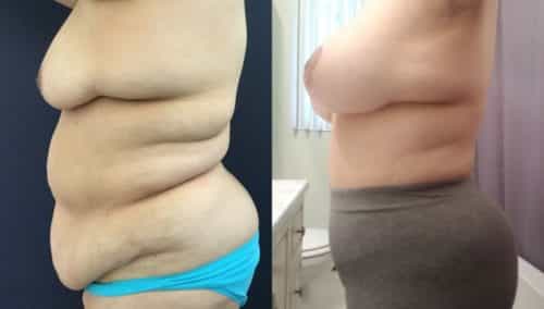 after weight loss colombia 174-2-min