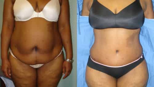 after weight loss colombia 19-1-min
