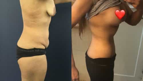 after weight loss colombia 236-2-min