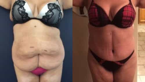 after weight loss colombia 237-1-min