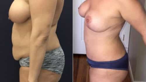 after weight loss colombia 288-3-min