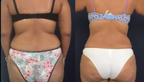after weight loss colombia 41-4-min