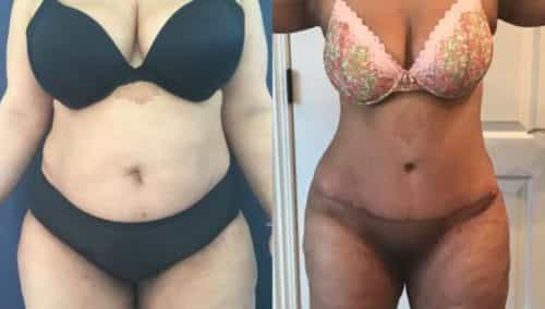 after weight loss colombia 80-1-min