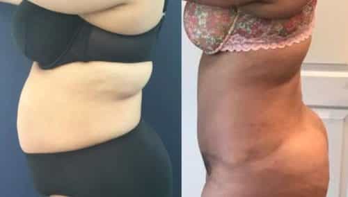 after weight loss colombia 80-2-min