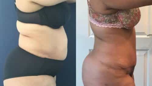 after weight loss colombia 80-3-min