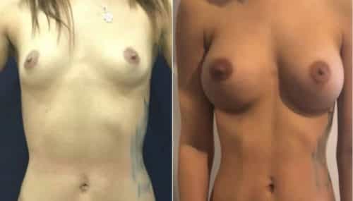 breast augmentation colombia 107-1 -min
