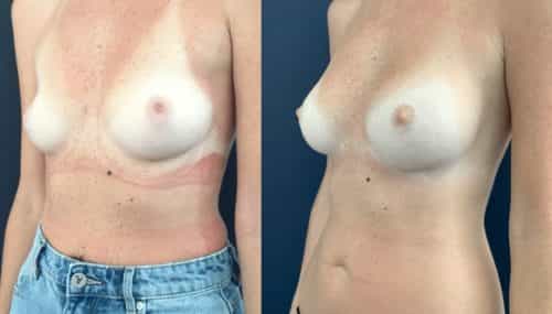 breast augmentation colombia 108-2-min