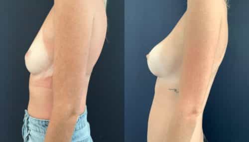 breast augmentation colombia 108-3-min