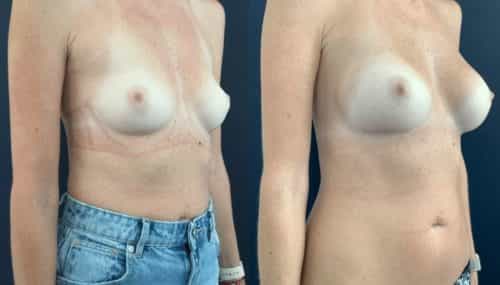 breast augmentation colombia 108-4-min