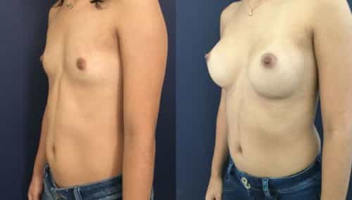 breast augmentation colombia 202-2-min