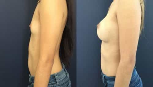 breast augmentation colombia 202-3-min