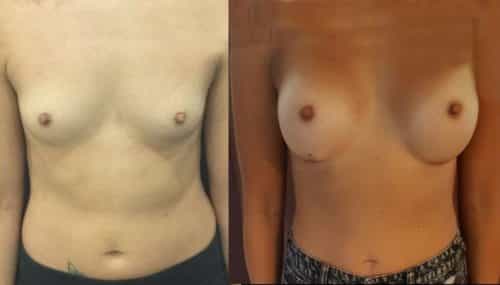 breast augmentation colombia 214-1-min
