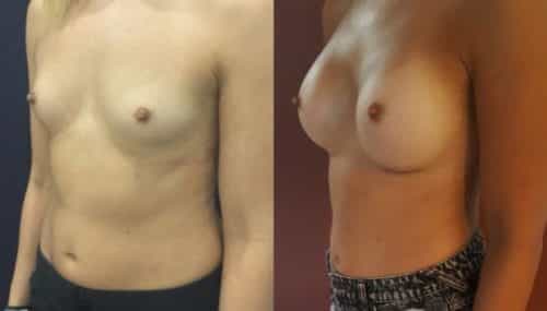 breast augmentation colombia 214-2-min