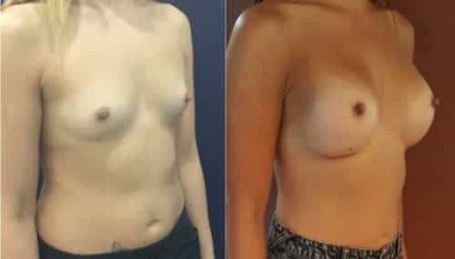 breast augmentation colombia 214-4-min