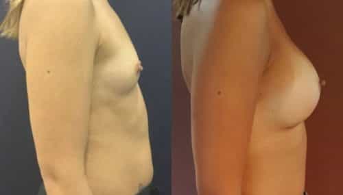 breast augmentation colombia 214-5-min