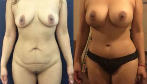 breast augmentation colombia 219-1-min