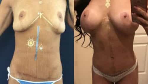 breast augmentation colombia 223-1-min