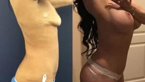 breast augmentation colombia 223-2-min