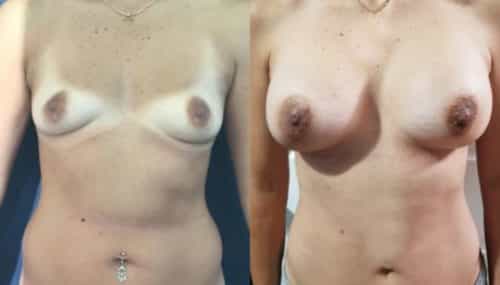 breast augmentation colombia 227-1-min