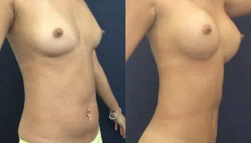 breast augmentation colombia 231-4-min