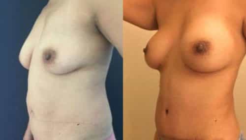 breast augmentation colombia 254-2-min