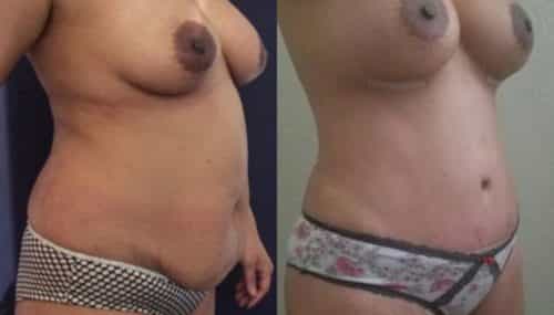 breast augmentation colombia 257-4-min