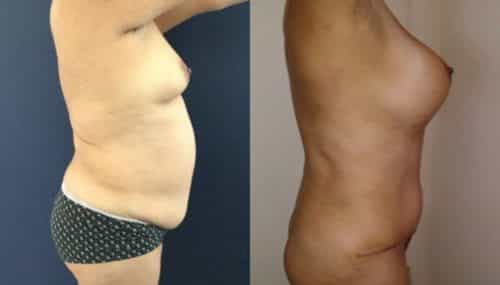 breast augmentation colombia 261-5-min