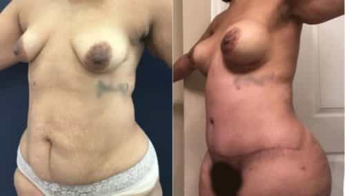 breast augmentation colombia 265-2-min