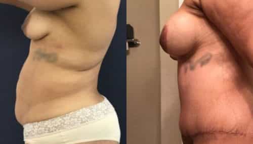 breast augmentation colombia 265-3-min