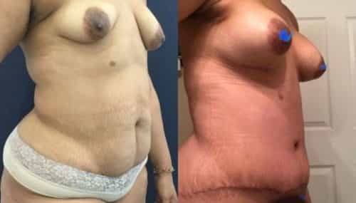 breast augmentation colombia 265-4-min