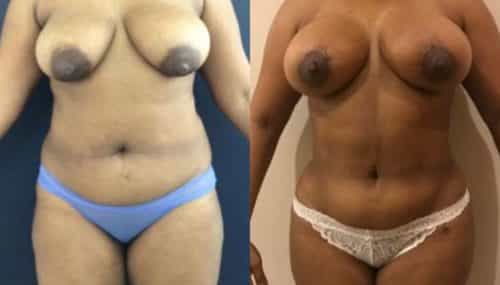 breast augmentation colombia 279-1-min