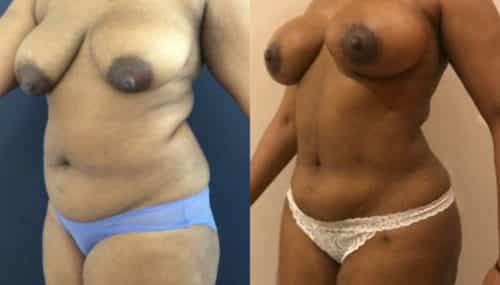breast augmentation colombia 279-2-min