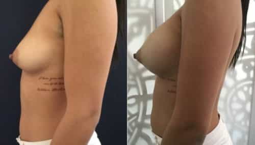 breast augmentation colombia 292-3-min