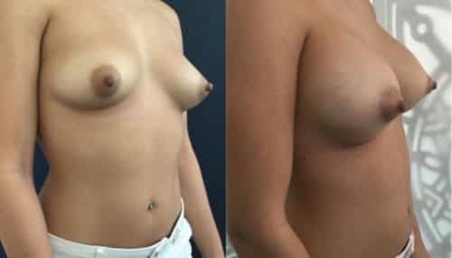 breast augmentation colombia 292-4-min