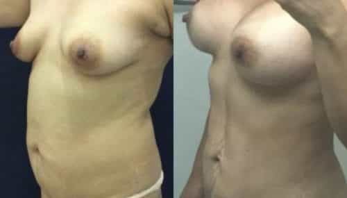 breast augmentation colombia 300-2-min