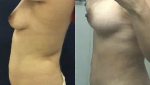 breast augmentation colombia 300-3-min