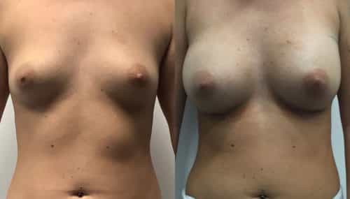 breast augmentation colombia 315-1-min