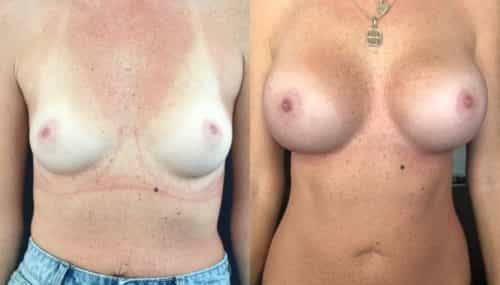 breast augmentation colombia 344-1-min
