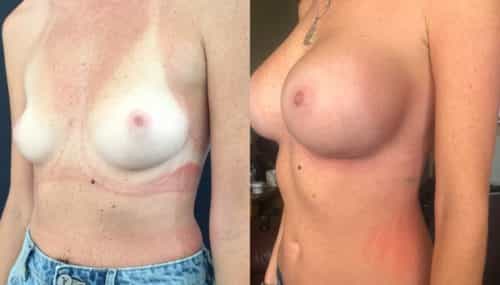 breast augmentation colombia 344-2-min