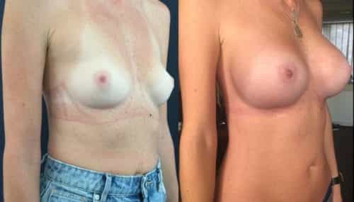 breast augmentation colombia 344-4-min