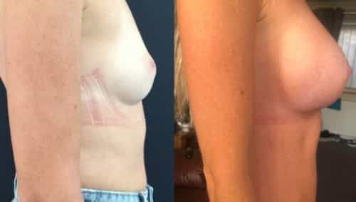breast augmentation colombia 344-5-min