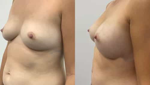 breast augmentation colombia 365-4-min