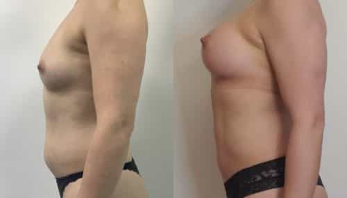 breast augmentation colombia 366-3-min