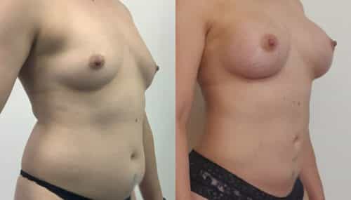 breast augmentation colombia 366-4-min
